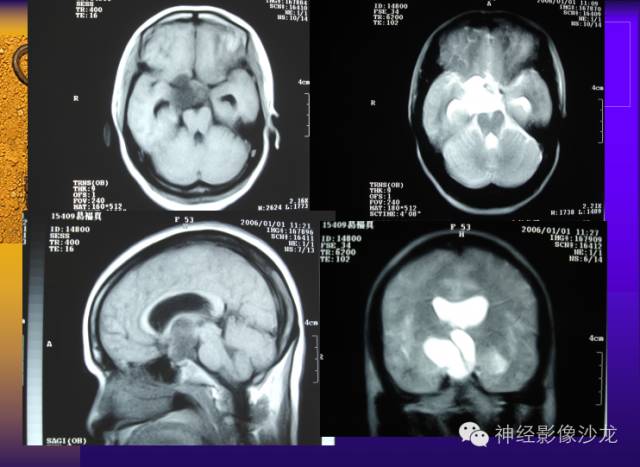 【病例】颅内鞍区病变七例鉴别诊断分析 【病例】颅内鞍区病变七例鉴别诊断分析