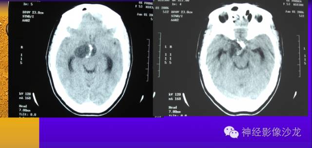 【病例】颅内鞍区病变七例鉴别诊断分析 【病例】颅内鞍区病变七例鉴别诊断分析