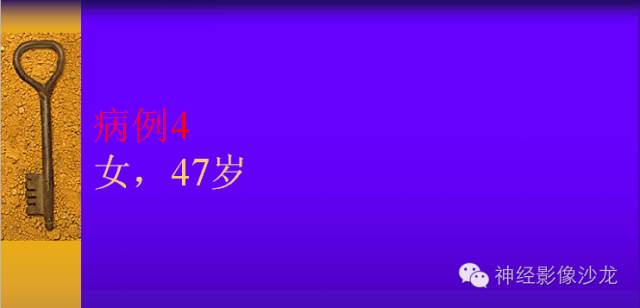 【病例】颅内鞍区病变七例鉴别诊断分析 【病例】颅内鞍区病变七例鉴别诊断分析