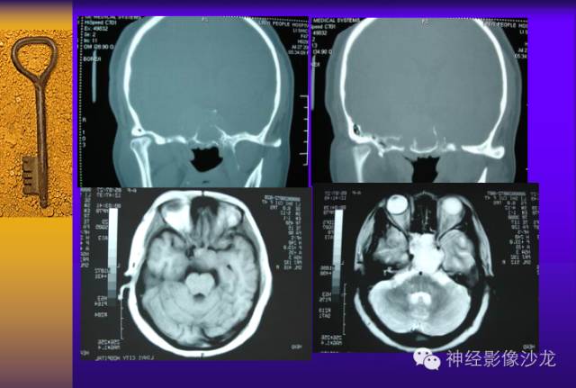 【病例】颅内鞍区病变七例鉴别诊断分析 【病例】颅内鞍区病变七例鉴别诊断分析