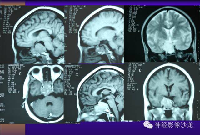 【病例】颅内鞍区病变七例鉴别诊断分析 【病例】颅内鞍区病变七例鉴别诊断分析
