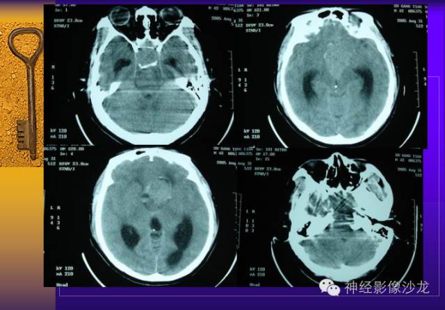 【病例】颅内鞍区病变七例鉴别诊断分析 【病例】颅内鞍区病变七例鉴别诊断分析