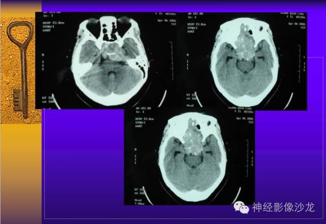 【病例】颅内鞍区病变七例鉴别诊断分析 【病例】颅内鞍区病变七例鉴别诊断分析