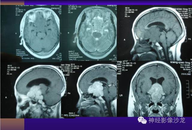 【病例】颅内鞍区病变七例鉴别诊断分析 【病例】颅内鞍区病变七例鉴别诊断分析