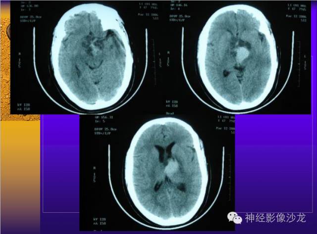 【病例】颅内鞍区病变七例鉴别诊断分析 【病例】颅内鞍区病变七例鉴别诊断分析