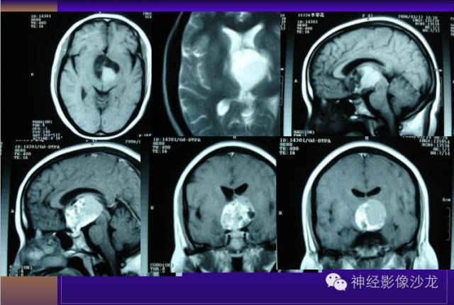 【病例】颅内鞍区病变七例鉴别诊断分析 【病例】颅内鞍区病变七例鉴别诊断分析