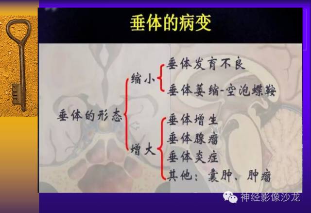 【病例】颅内鞍区病变七例鉴别诊断分析 【病例】颅内鞍区病变七例鉴别诊断分析