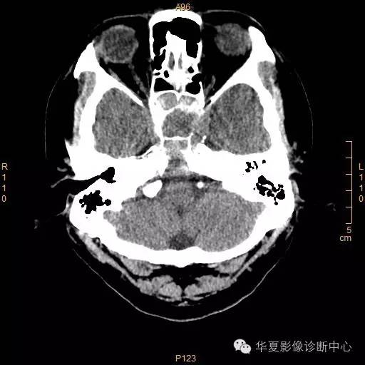 【病例】垂体大腺瘤合并出血囊变1例MR影像表现