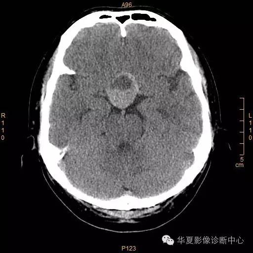 【病例】垂体大腺瘤合并出血囊变1例MR影像表现