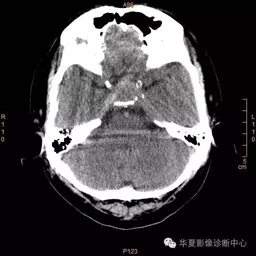 【病例】垂体大腺瘤合并出血囊变1例MR影像表现