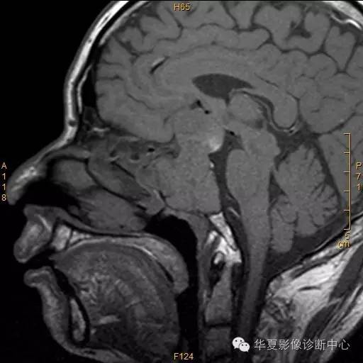 【病例】垂体大腺瘤合并出血囊变1例MR影像表现