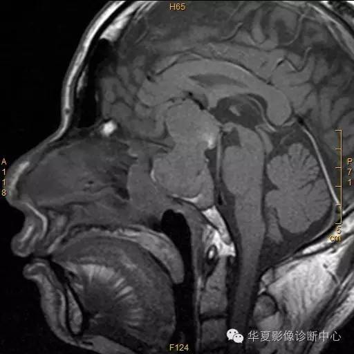 【病例】垂体大腺瘤合并出血囊变1例MR影像表现