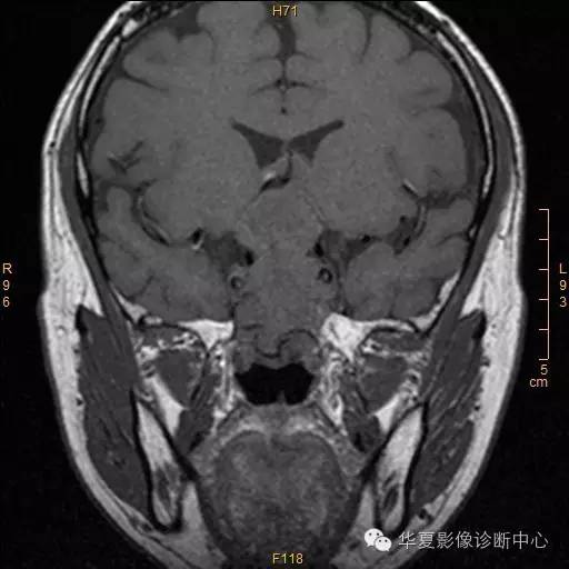 【病例】垂体大腺瘤合并出血囊变1例MR影像表现