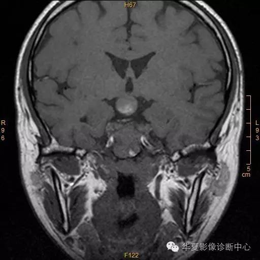 【病例】垂体大腺瘤合并出血囊变1例MR影像表现