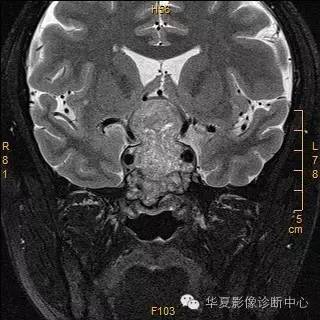 【病例】垂体大腺瘤合并出血囊变1例MR影像表现