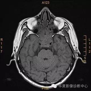 【病例】垂体大腺瘤合并出血囊变1例MR影像表现