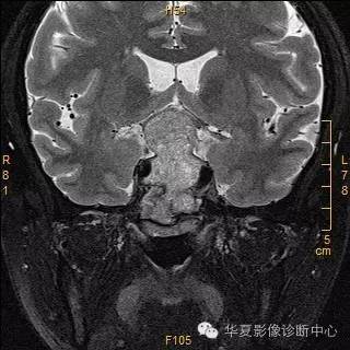 【病例】垂体大腺瘤合并出血囊变1例MR影像表现