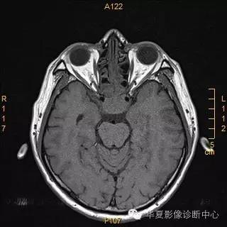 【病例】垂体大腺瘤合并出血囊变1例MR影像表现