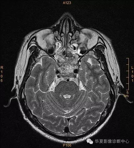 【病例】垂体大腺瘤合并出血囊变1例MR影像表现