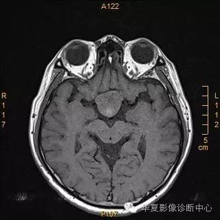 【病例】垂体大腺瘤合并出血囊变1例MR影像表现