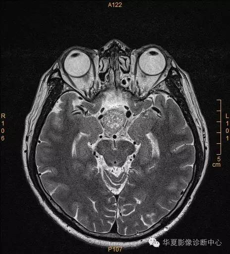 【病例】垂体大腺瘤合并出血囊变1例MR影像表现