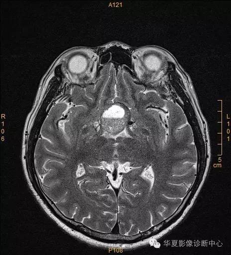 【病例】垂体大腺瘤合并出血囊变1例MR影像表现