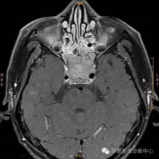 【病例】垂体大腺瘤合并出血囊变1例MR影像表现