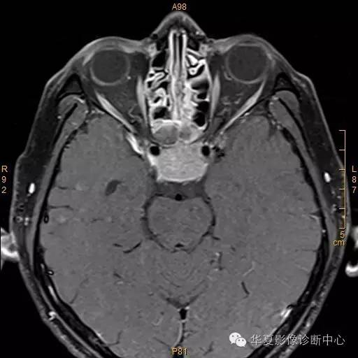 【病例】垂体大腺瘤合并出血囊变1例MR影像表现
