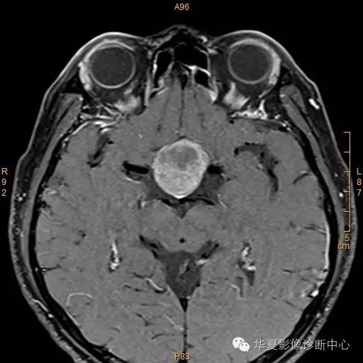 【病例】垂体大腺瘤合并出血囊变1例MR影像表现