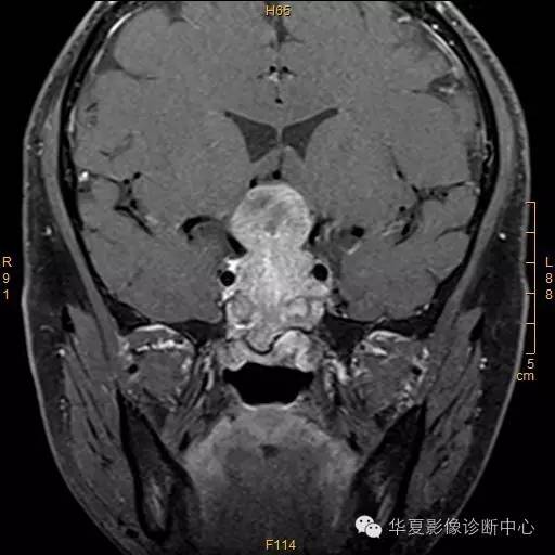 【病例】垂体大腺瘤合并出血囊变1例MR影像表现