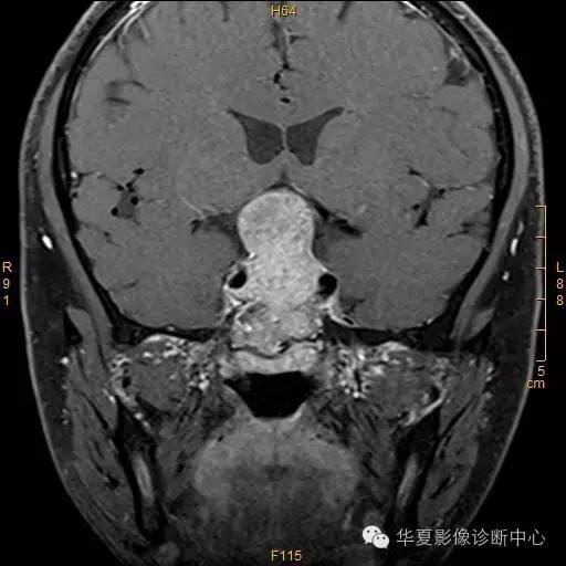 【病例】垂体大腺瘤合并出血囊变1例MR影像表现