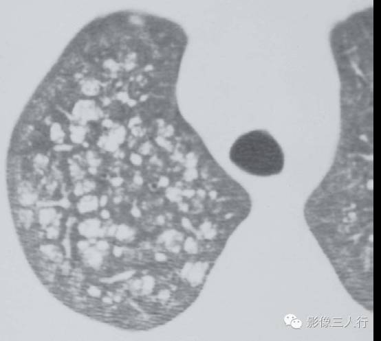 肺转移性钙化