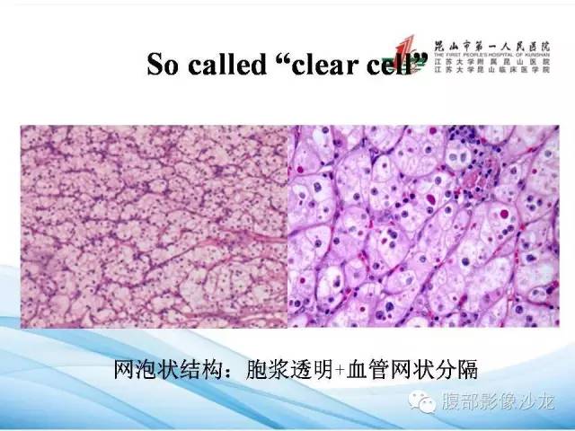 【PPT】透明细胞肾癌的诊断与鉴别