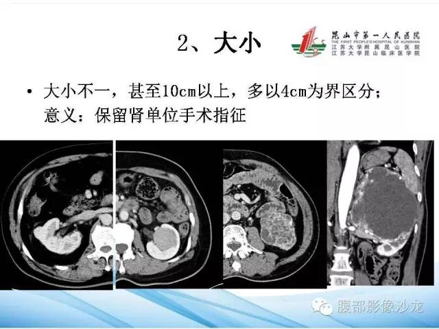 【PPT】透明细胞肾癌的诊断与鉴别