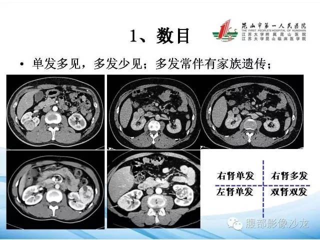 【PPT】透明细胞肾癌的诊断与鉴别