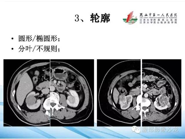 【PPT】透明细胞肾癌的诊断与鉴别