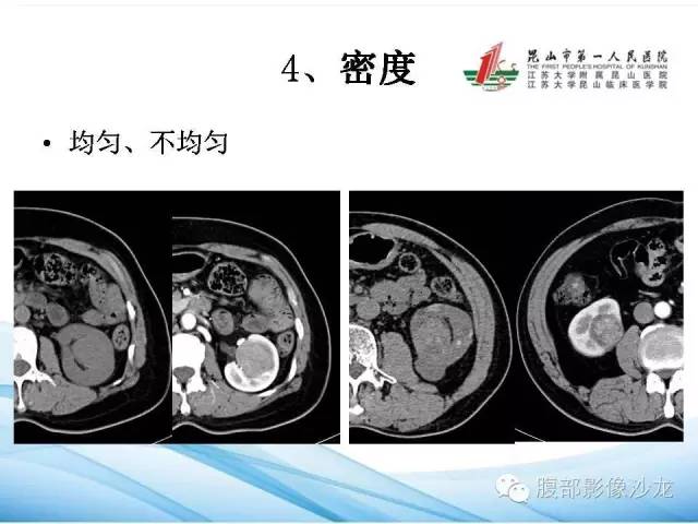 【PPT】透明细胞肾癌的诊断与鉴别