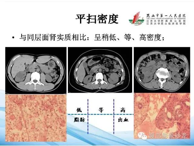 【PPT】透明细胞肾癌的诊断与鉴别