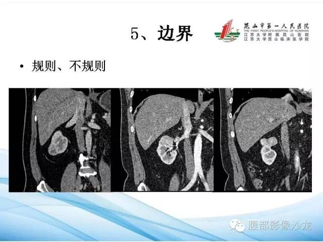 【PPT】透明细胞肾癌的诊断与鉴别