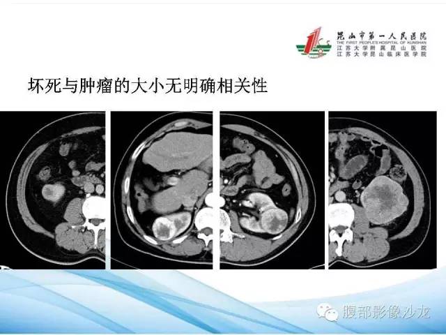 【PPT】透明细胞肾癌的诊断与鉴别