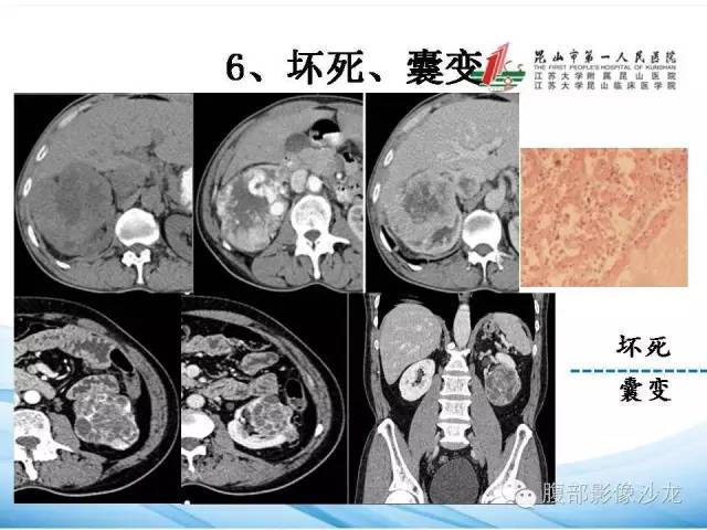 【PPT】透明细胞肾癌的诊断与鉴别