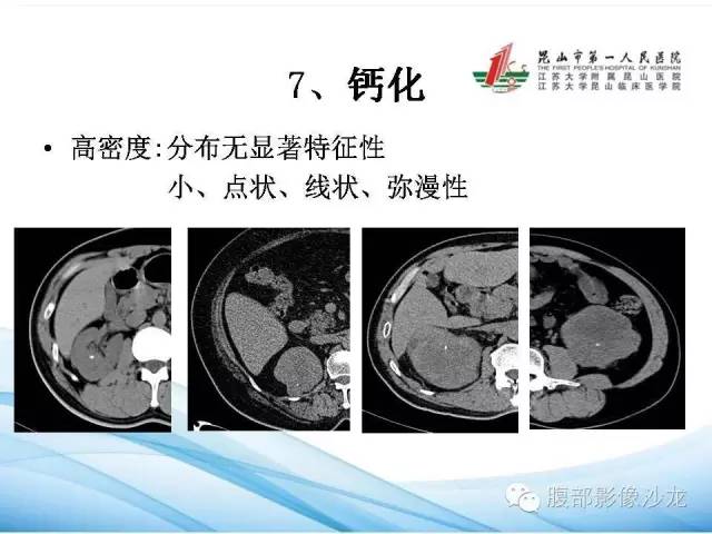 【PPT】透明细胞肾癌的诊断与鉴别