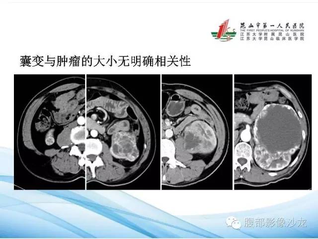 【PPT】透明细胞肾癌的诊断与鉴别
