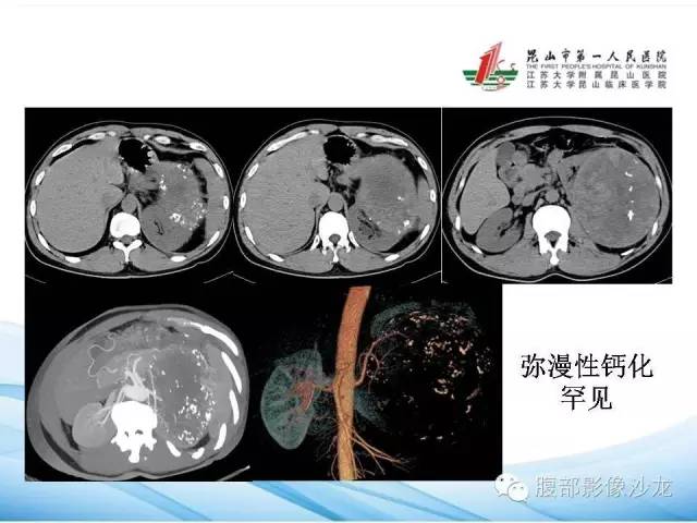【PPT】透明细胞肾癌的诊断与鉴别