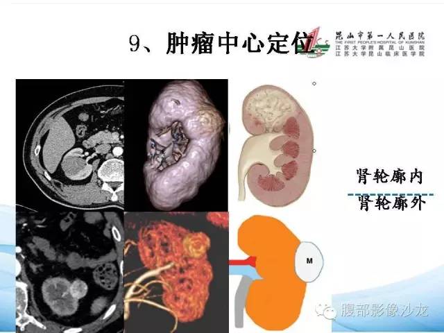 【PPT】透明细胞肾癌的诊断与鉴别