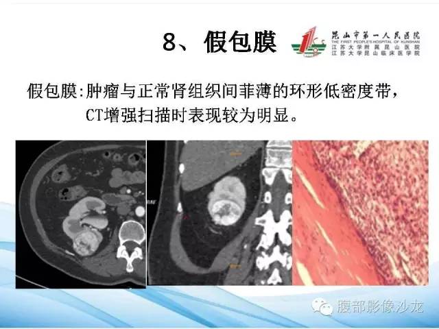 【PPT】透明细胞肾癌的诊断与鉴别