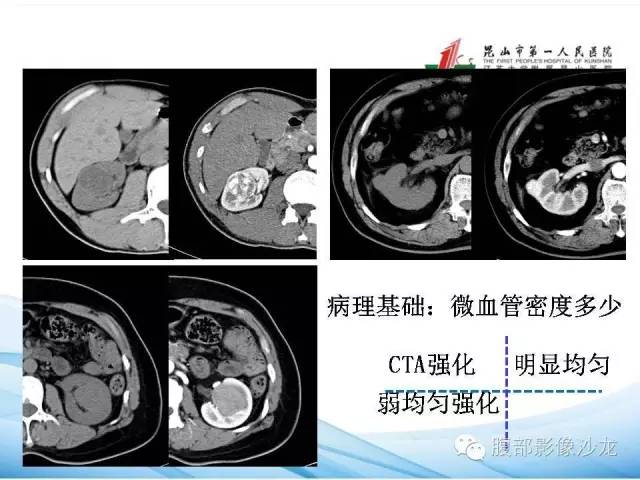 【PPT】透明细胞肾癌的诊断与鉴别