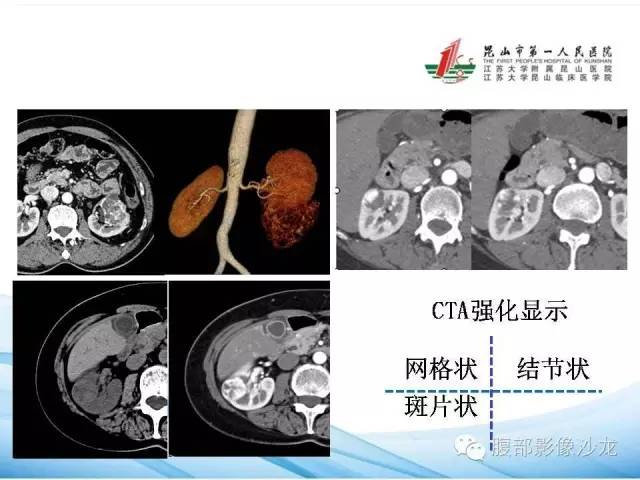 【PPT】透明细胞肾癌的诊断与鉴别