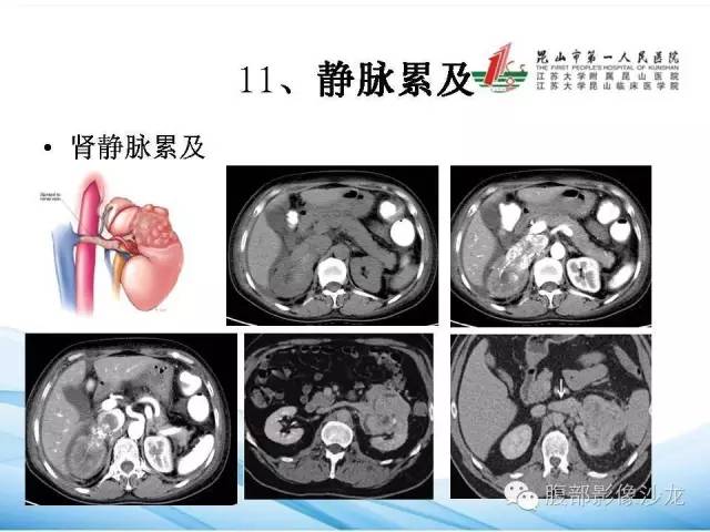 【PPT】透明细胞肾癌的诊断与鉴别