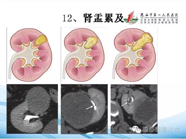 【PPT】透明细胞肾癌的诊断与鉴别